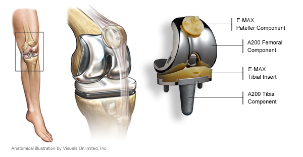 Knee Replacement Information for Patients